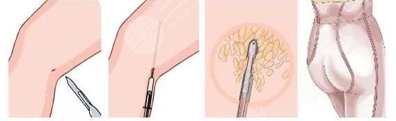 腿部吸脂手术多少钱一次啊？腿部吸脂手术潜在的危害有哪些？