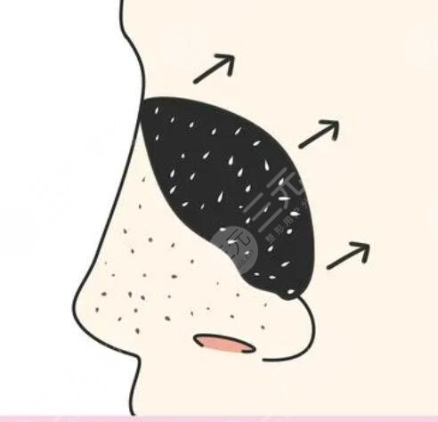 如何收缩鼻头毛孔粗大小妙招,告别鼻头黑点点!