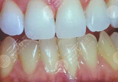 冷光美白牙齿对牙齿有什么伤害？