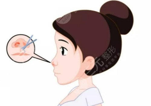 北京金燕子医疗美容诊所隆鼻怎么样?