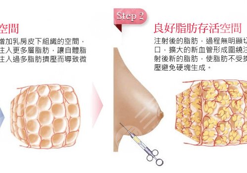 胸部一大一小怎么办?