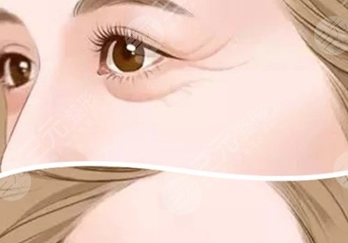 鱼尾纹怎么才能去掉？