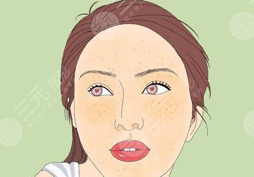 怎样去除面部黄褐斑有效？