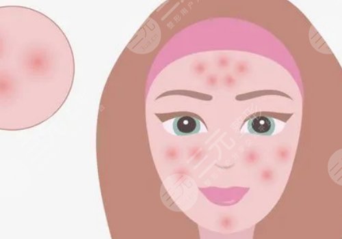 脸上有痘印怎么办才能去掉呢？