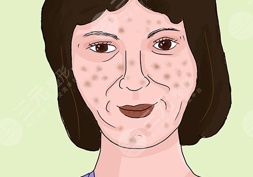 脸上的色斑怎么去掉(淡化)？