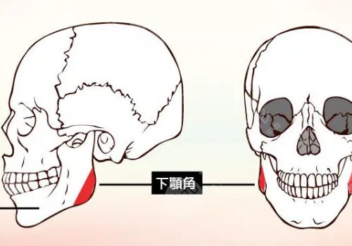 下颌角宽大怎么改良？