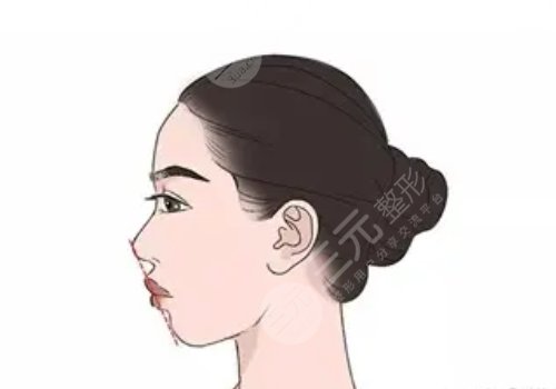 上海美联臣(愉悦薇莱医疗美容医院)做下颌角怎么样?