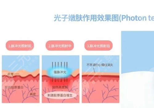 彩光嫩肤和光子嫩肤有什么区别？