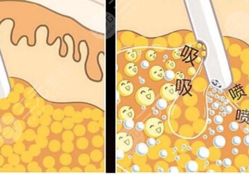 腹部抽脂术后需要修复多久？