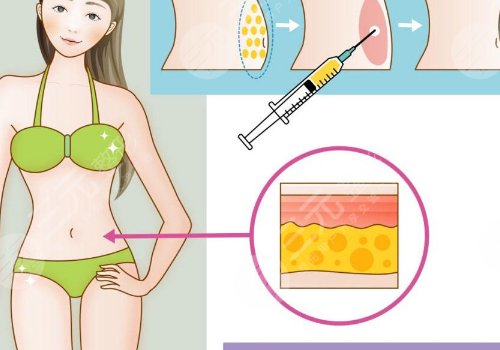 腹部抽脂术后需要修复多久？