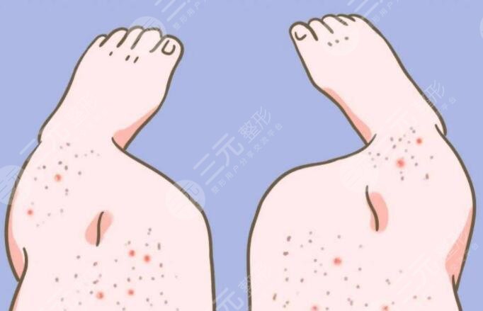 鸡皮疙瘩皮肤怎么治比较好？鸡皮疙瘩皮肤形成原因及日常护理