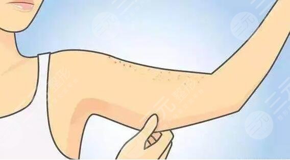 鸡皮疙瘩皮肤怎么治比较好?