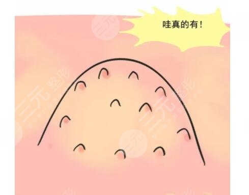 鸡皮疙瘩是什么病?