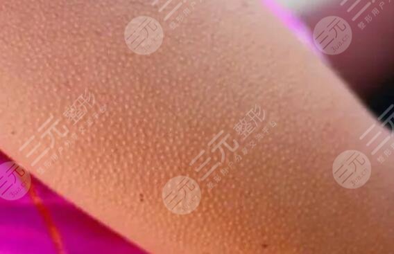 出现鸡皮疙瘩应该注意哪些问题?