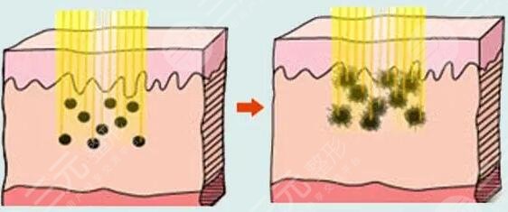 激光嫩肤的作用有哪些?