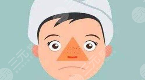 激光缓解鼻子痤疮效果如何?