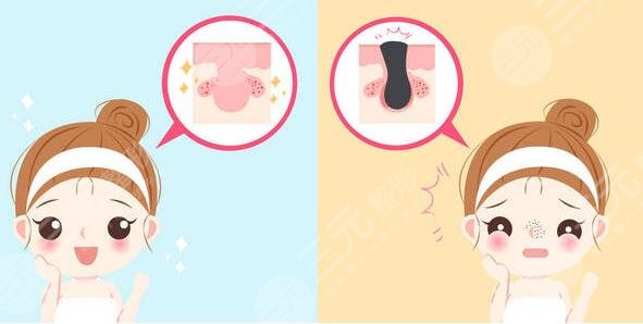 激光缓解鼻子痤疮注意事项有哪些?