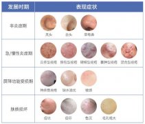 怎么去痘印快？3种方案对比，美肤！