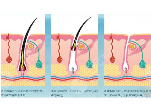 男士激光脱毛效果如何?