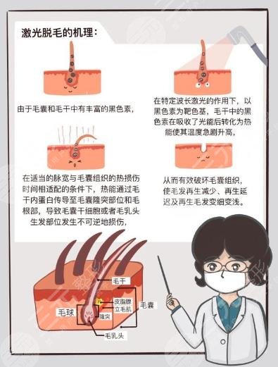 男士激光脱毛效果如何?