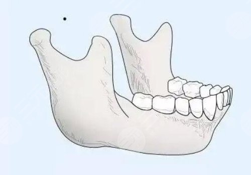下颌角宽大怎么改良？