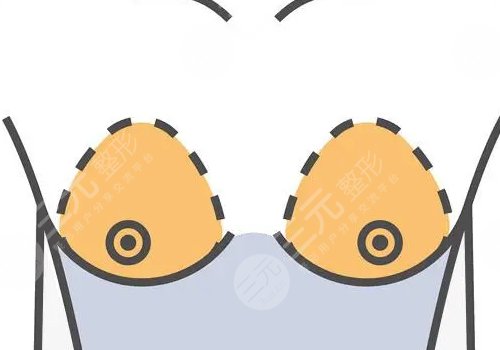 傲若拉假体怎么样?