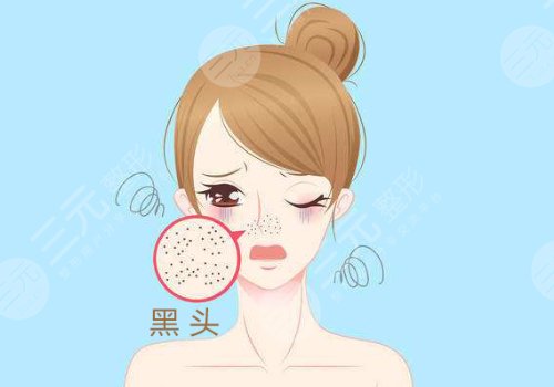 黑头怎么去除有效？