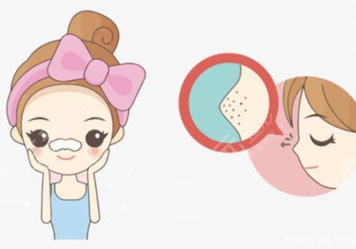 黑头怎么去除有效？