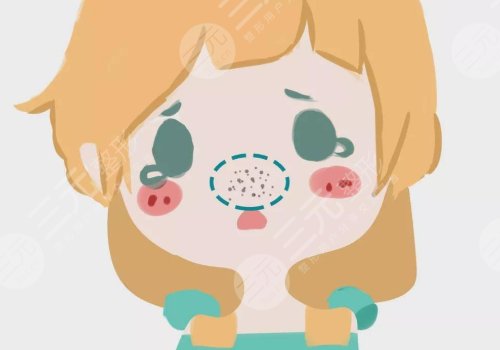 黑头怎么去除有效？