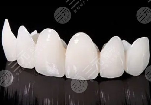 烤瓷牙多少钱一颗？