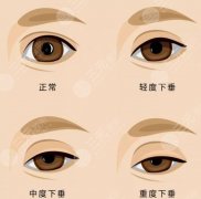上睑下垂矫正手术一般多少钱？价格决定因素有2点！