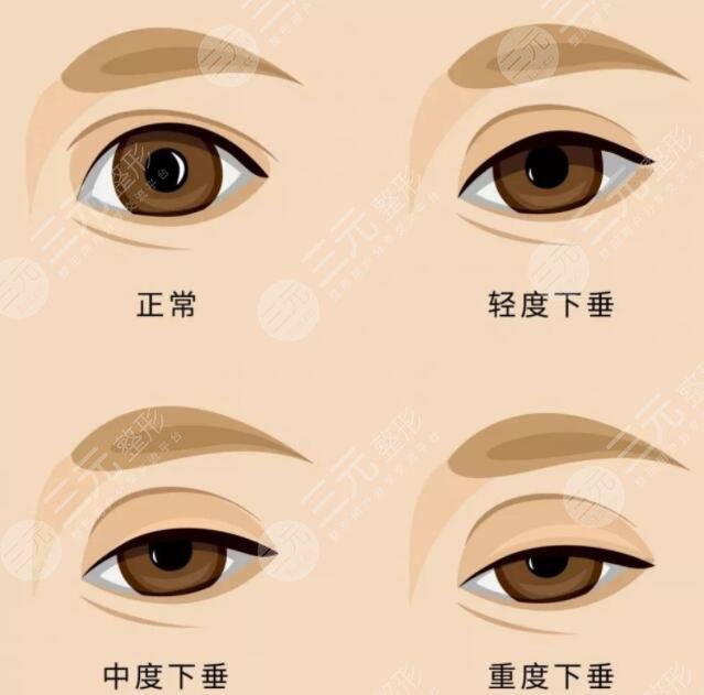 上睑下垂矫正手术一般多少钱？价格决定因素有2点！