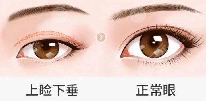 上睑下垂矫正手术一般多少钱?