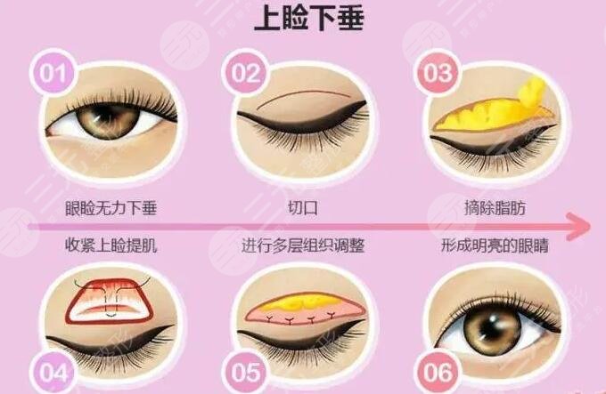 上睑下垂矫正难吗?