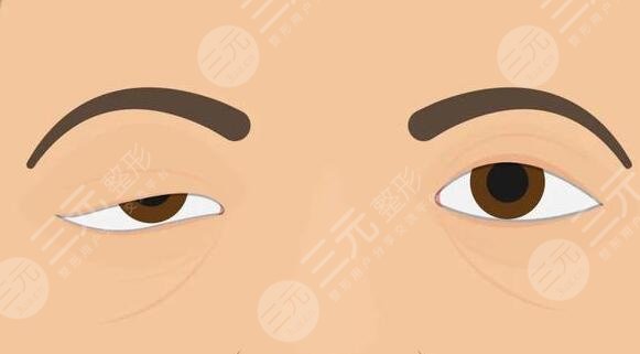 上睑下垂矫正手术有风险吗?