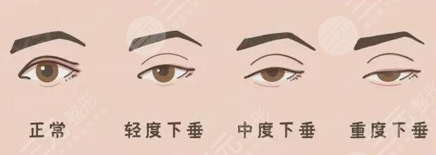 上睑下垂矫正手术需要注意哪些问题?