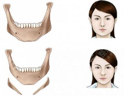 下颌角整形手术