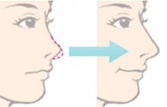 怎样让鼻梁变高？4种方案分享！隆鼻价格_手术常识