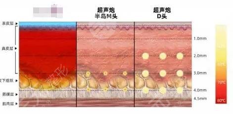 7d聚拉提和半岛超声炮的区别