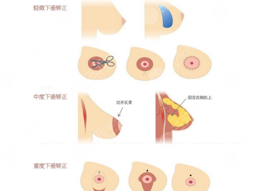 乳房悬吊术可以维持多久?