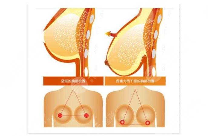 乳房悬吊术可以维持多久?
