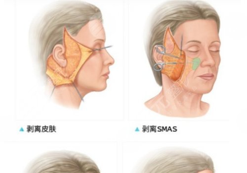 沈阳杏林拉皮哪位大夫手术费高?