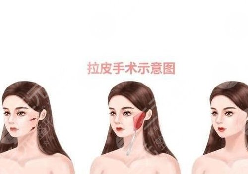 沈阳杏林拉皮的案例有吗?