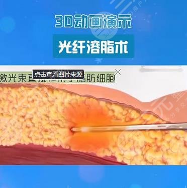 光纤溶脂的危害有哪些