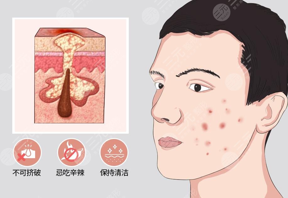 红蓝光祛痘效果好吗?