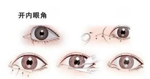 开眼角会使眼睛放大吗?
