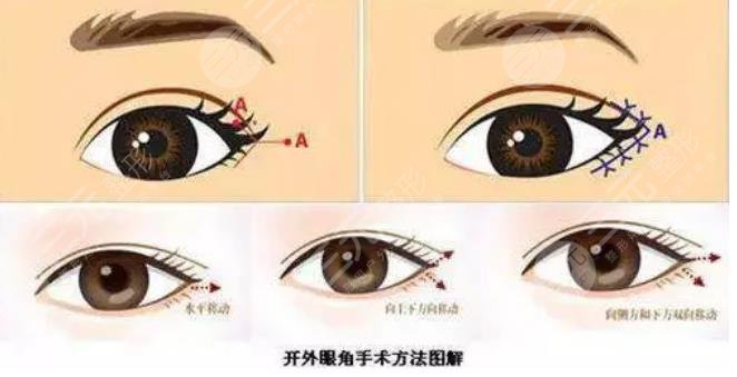 开眼角会使眼睛放大吗?