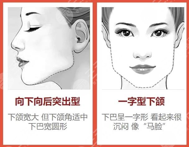 削骨手术一般要多少钱？