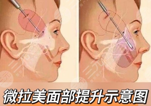 做薇拉美的线多长时间能吸收完?