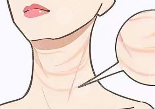 颈纹填充能维持多久呢?色素沉着能消退吗?